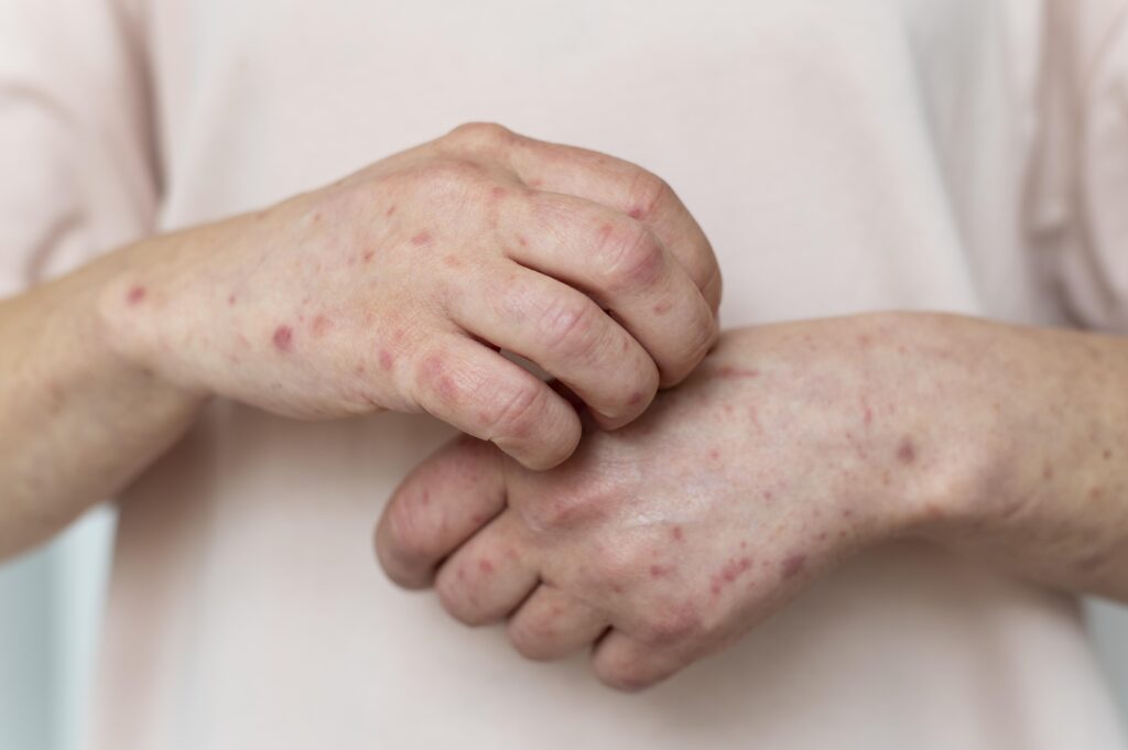 dermatitis en manos