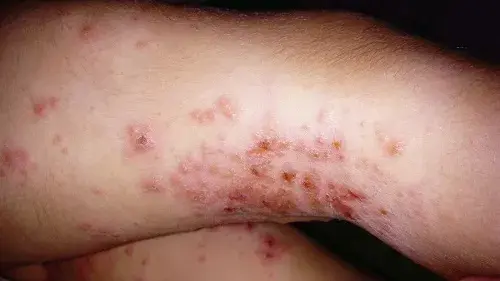 Eccema herpético (o la vez que más a cachos me he caído)